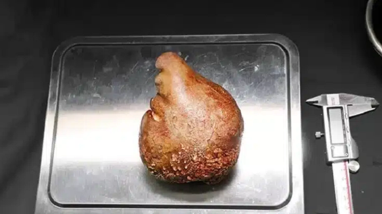 Dünyanın en büyük böbrek taşı çıkarıldı: 801 gram ağırlığında